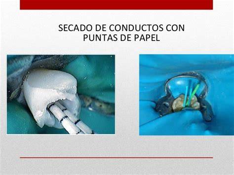 Secado del conducto radicular con puntas de papel