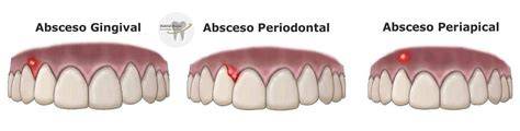 Radiografía y diagnóstico de absceso dental