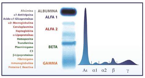 Electroforesis de proteínas séricas