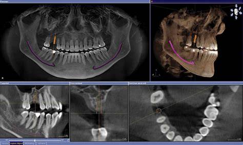 Tomografía dental y tabla cortical externa