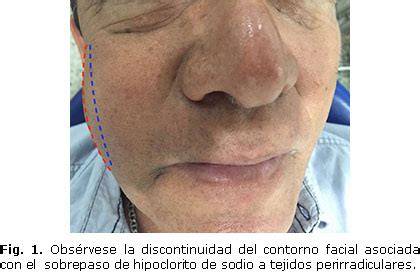 Hematoma facial por extrusión de hipoclorito