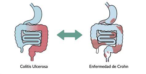 perfiles psicosociales enfermedad de Crohn colitis