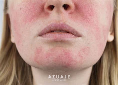 Rosácea facial y zonas afectadas