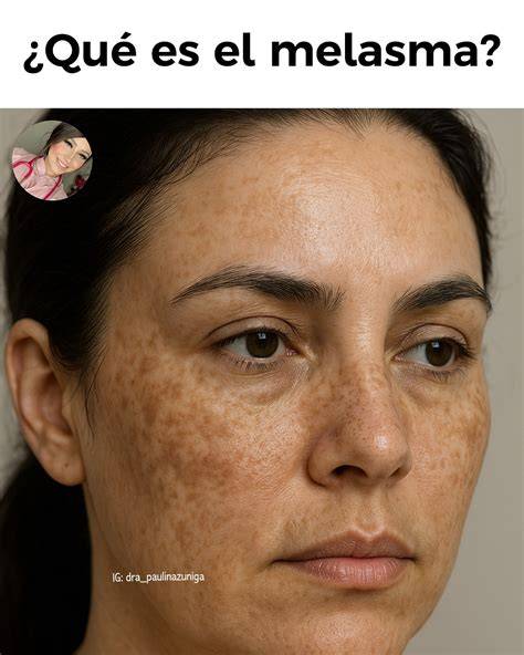 Melasma en labio superior y protección solar