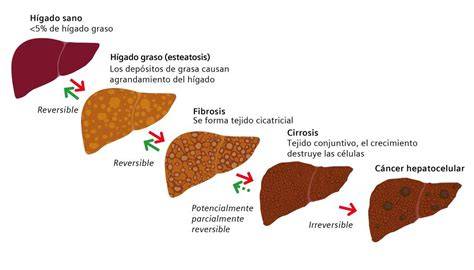 Esteatosis hepática o hígado graso
