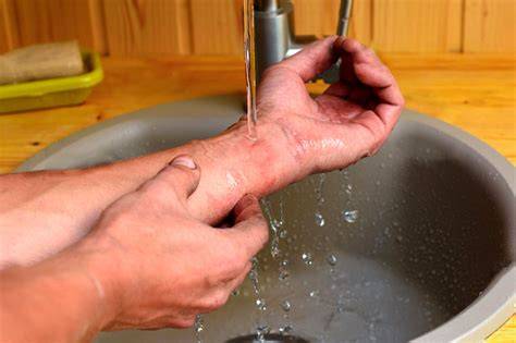 mano bajo agua corriente para quemadura