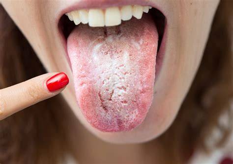 Lengua con placas blancas por candidiasis oral