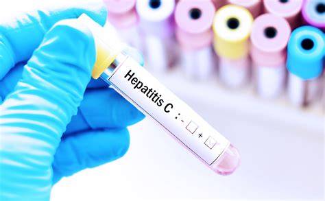 seguimiento médico durante tratamiento hepatitis C