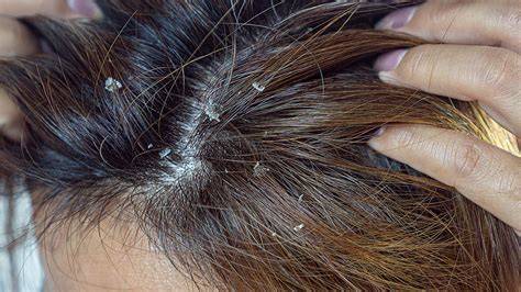 Dermatitis y descamación del cuero cabelludo