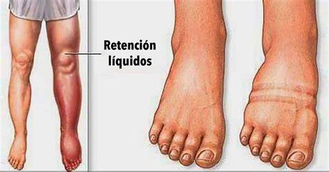 Retención de líquidos en piernas y tobillos