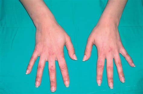 Lesiones equimóticas y edema en glúteos
