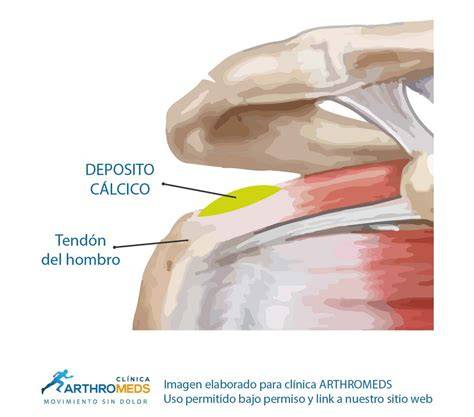 Depósitos de calcio en tendones del hombro