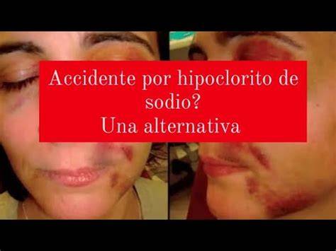 Accidente con hipoclorito y hematoma facial