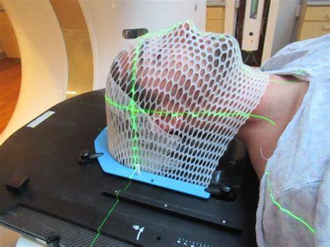 Mascarilla termoplástica de radioterapia